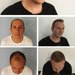 Haarimplantat Ergebnisse der FUE Haartransplantation- PHAEYDE Cl