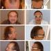 Hair Implant Konsultasjon - PHAEYDE Clinic