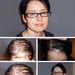 Hair Transplant for kvinner 3500 + hår - PHAEYDE Clinic