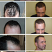 En typisk hårtransplantasjon med 3500 hår - PHAEYDE Clinic