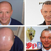Before&nbsp;after&nbsp;results&nbsp;of&nbsp;hair restoration&nbs