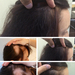Images&nbsp;done&nbsp;by&nbsp;FUE&nbsp;hair transplant&nbsp;in&n