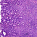 Adenocarcinoma ventriculi (diffuse type) 1