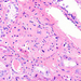 Amyloidosis renis (HE)2