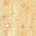 Amyloidosis renis2