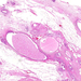 carcinoma lobulare invasivum mammae fibroysák