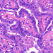 carcinoma papillare thyroideae magok tömörülése