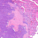 carcinoma papillare thyroideae0