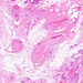 mastopathia fibrocystica cysták