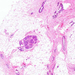 mastopathia fibrocystica ép lobulus