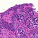 bronchus-metaplasia-dysplasia-carcinoma