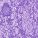 metastasis carcinomatosa lymphoglandularum folliculus + világos 