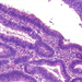 polypus adenomatosus coli többmagsor