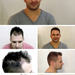 Haartransplantation Videos - PROHAARKLINIK