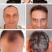 Haartransplantation Videos - PROHAARKLINIK