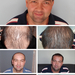 FUE Haartransplantation 8000+ - PROHAARKLINIK