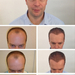 Haartransplantation Videos - PROHAARKLINIK