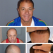 Ein weiterer 9000+ Haartransplantation - PROHAARKLINIK