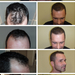 Haartransplantation Videos - PROHAARKLINIK